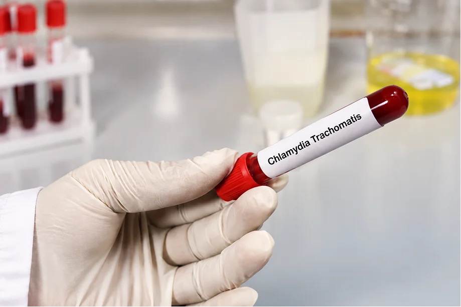 Chlamydia Testing and Treatment in Rapid Std Houston 